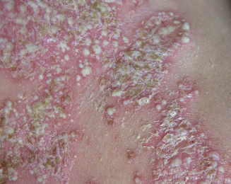 好的牛皮癣医院在哪