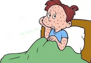 得了牛皮癣该怎么护理