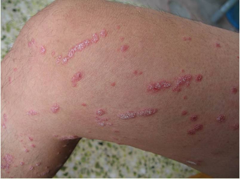 引发牛皮癣的常见原因