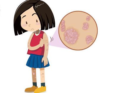 牛皮癣病人的疤痕如何去除