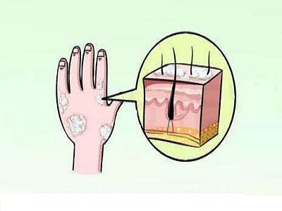 牛皮癣与其他疾病混淆不清