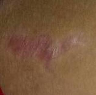 牛皮鲜痛痒难耐，抓破后应该如何护理