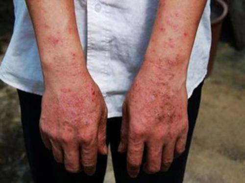 牛皮癣患者如何选择医院