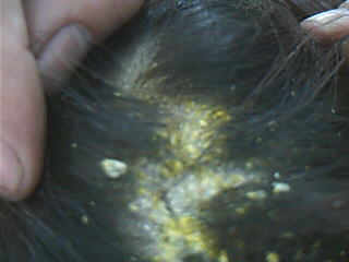 牛皮癣会引发哪些危害