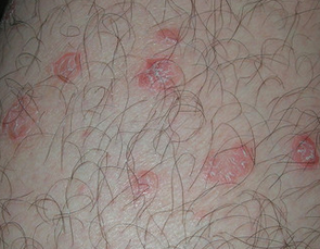 当牛皮鲜患者身体开始出现瘙痒该怎么办