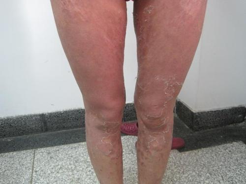 广州银屑病医院治疗如何