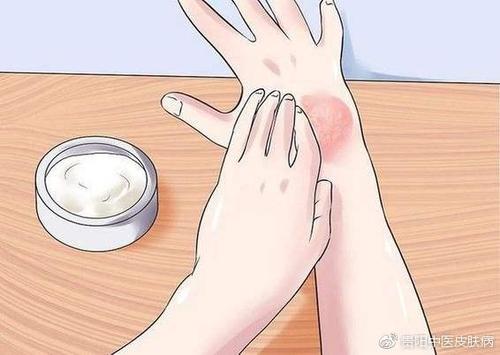 怎么抑制牛皮癣病情稳定不加重