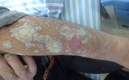 广州牛皮癣医院在哪