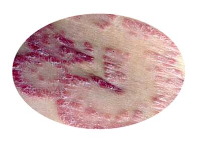 儿童银屑病症状