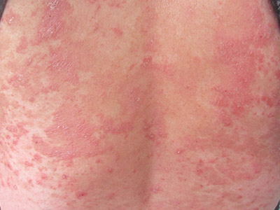 银屑病的症状是什么样的