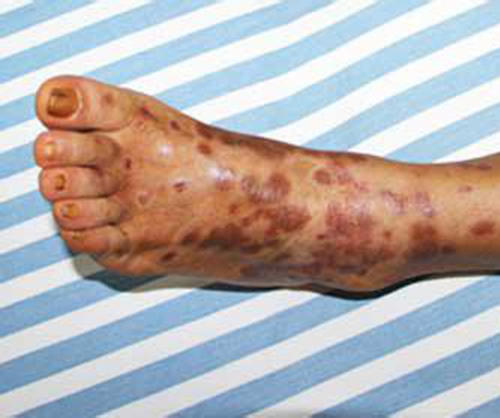 牛皮癣会传染吗