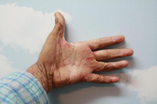 手足口病的症状