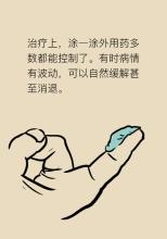 牛皮癣外用药会有哪些不良作用