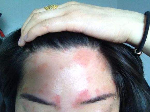 牛皮癣引起的脱发要如何护理和治疗