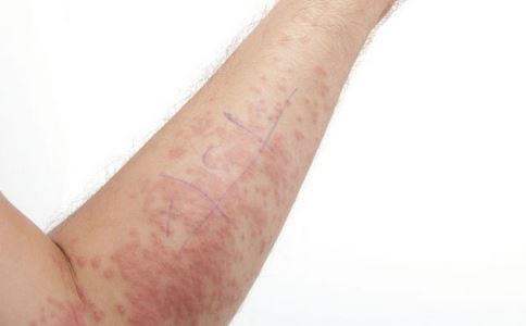 广州牛皮癣研究院探讨患者不能食物的食物有什么