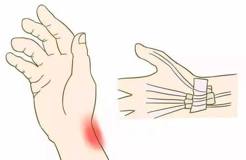 如何治疗关节型牛皮癣