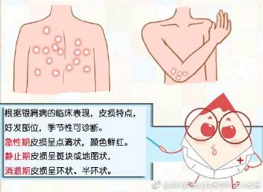 美食面前，牛皮癣患者要管住自己的嘴