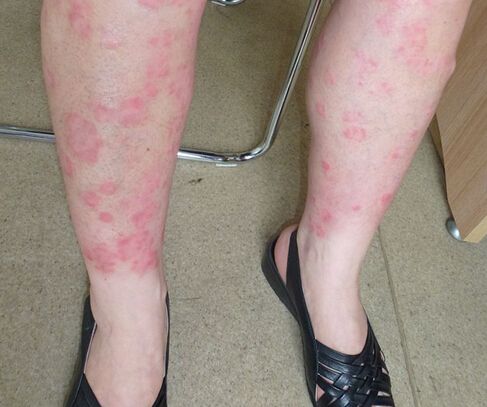 银屑病如何治效果好省钱