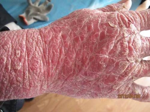 牛皮癣病情恶化-拖延也是病得治