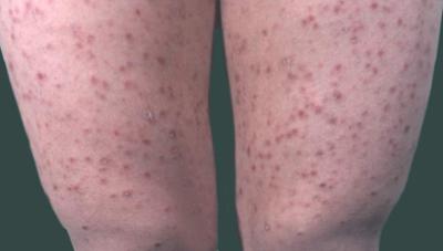 　科学治疗牛皮癣体现在何处