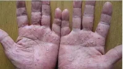 脓疱型牛皮藓发病的原因