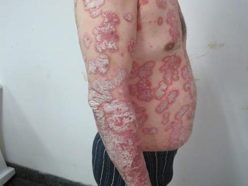 老年人患上银屑病的原因