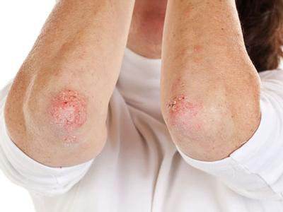 牛皮癣有什么需要关注的