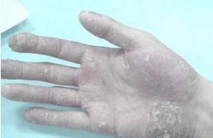 牛皮癣有什么危害