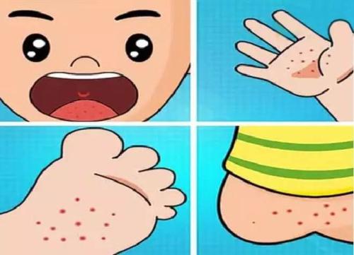 牛皮癣的主要症状