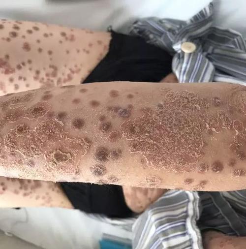 精神压力是牛皮癣发作的因素