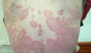 牛皮鲜皮损变化