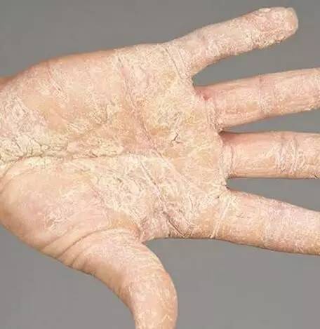 银屑病不是好东西