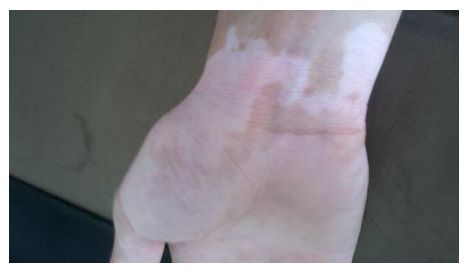 银屑病患者日常该如何护理