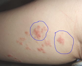 广州医生研究特殊部位银屑病的药物治疗