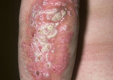 牛皮癣不治疗任其发展会如何