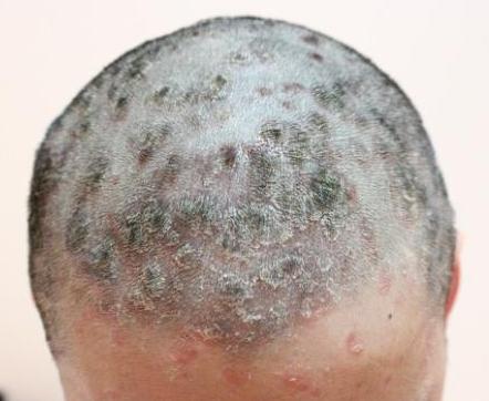 牛皮癣用什么方法治疗好