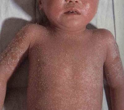 婴儿患上牛皮癣的诱发因素有哪些