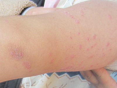 牛皮癣的哪些危害得警惕