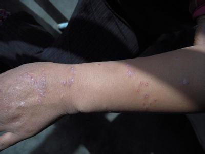 选择牛皮癣医院有哪些条件