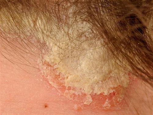 广州看银屑病医院