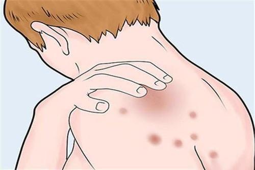 不适合牛皮癣患者的工作