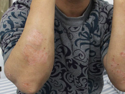 问广州医生银屑病的治疗为什么没有效果