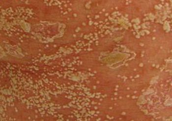 银屑病临床症状表现