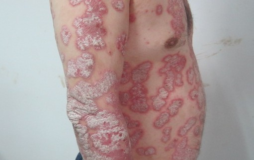 治疗牛皮癣需要注意什么？