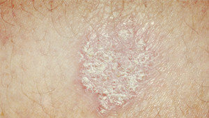 治疗牛皮癣多久痊愈