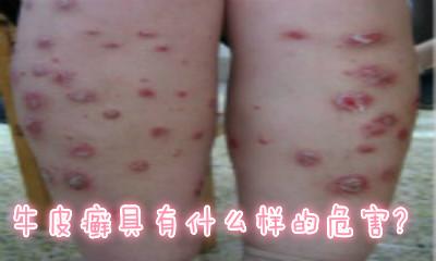 银屑病带来的危害