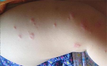 牛皮癣患者的皮肤为什么总是很干燥问广州治疗医生