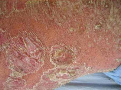 如何治疗牛皮癣避免病情反复