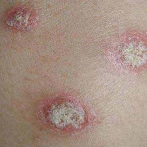 牛皮癣治疗需要坚持的四大原则