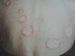 诱发牛皮癣发病的病因